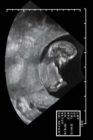 Prenatal Ultrasound Android Lifestyle